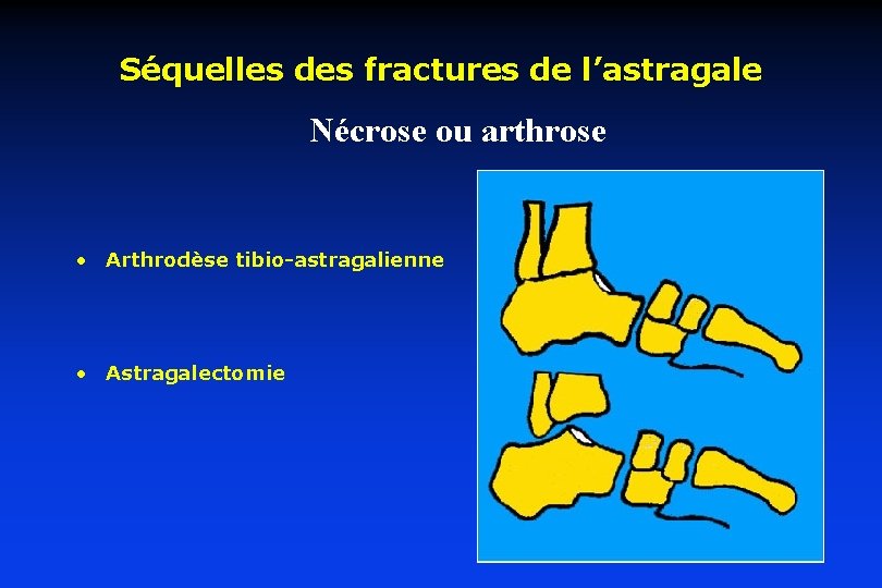 Séquelles des fractures de l’astragale Nécrose ou arthrose • Arthrodèse tibio-astragalienne • Astragalectomie 