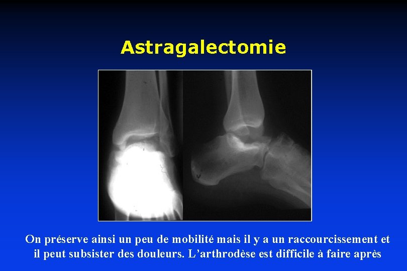 Astragalectomie On préserve ainsi un peu de mobilité mais il y a un raccourcissement