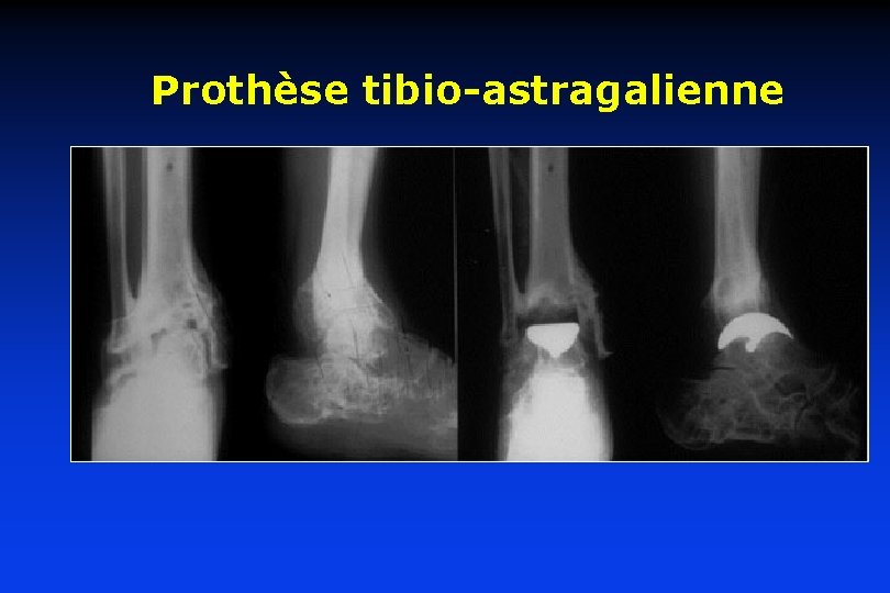 Prothèse tibio-astragalienne 