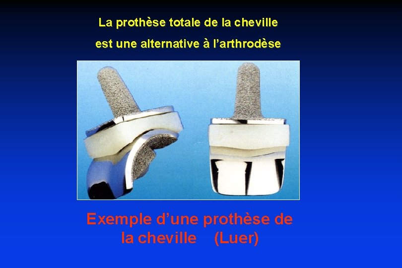 La prothèse totale de la cheville est une alternative à l’arthrodèse Exemple d’une prothèse