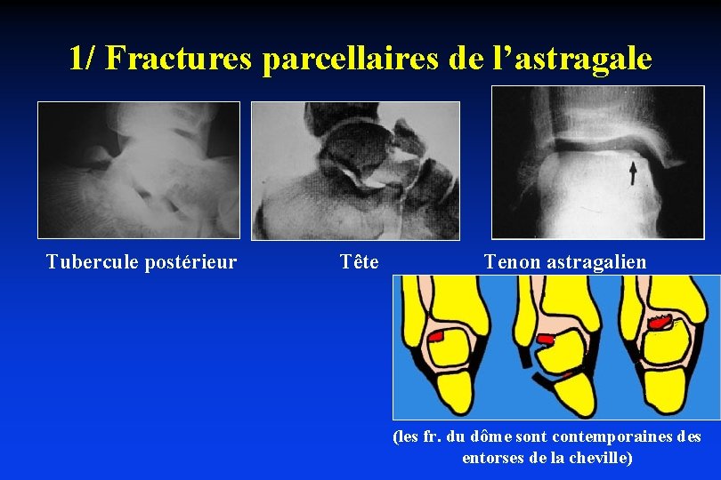 1/ Fractures parcellaires de l’astragale Tubercule postérieur Tête Tenon astragalien (les fr. du dôme