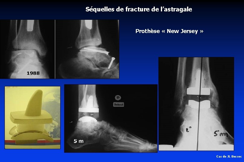 Séquelles de fracture de l’astragale Prothèse « New Jersey » Cas de JL Bessec