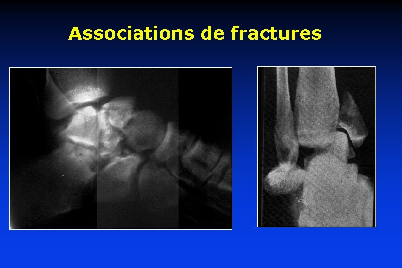 Associations de fractures 