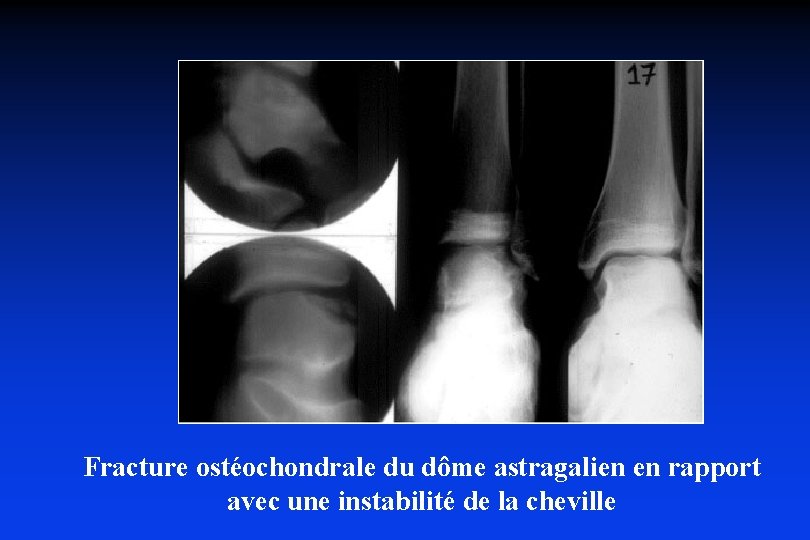 Fracture ostéochondrale du dôme astragalien en rapport avec une instabilité de la cheville 