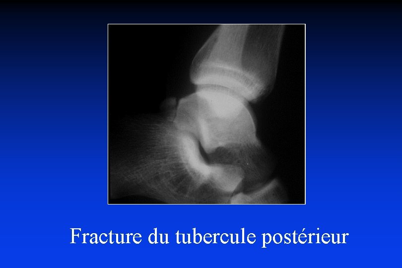 Fracture du tubercule postérieur 