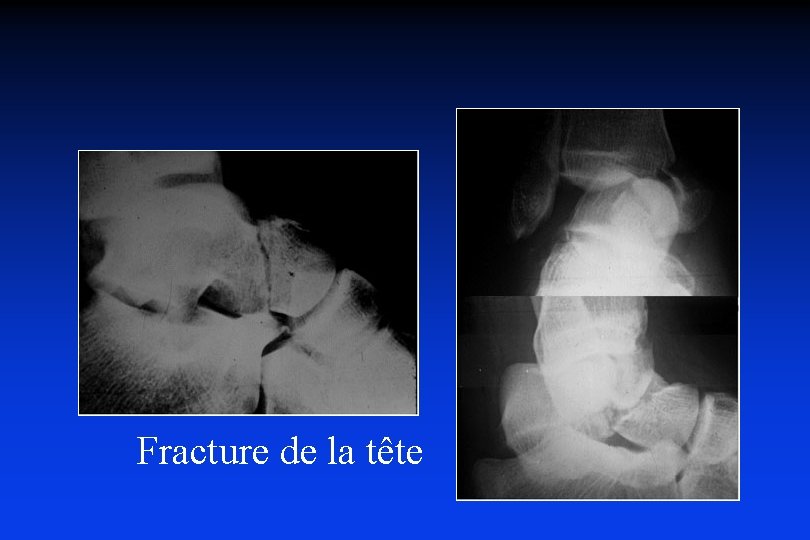 Fracture de la tête 