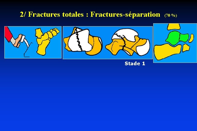 2/ Fractures totales : Fractures-séparation Stade 1 (70 %) 