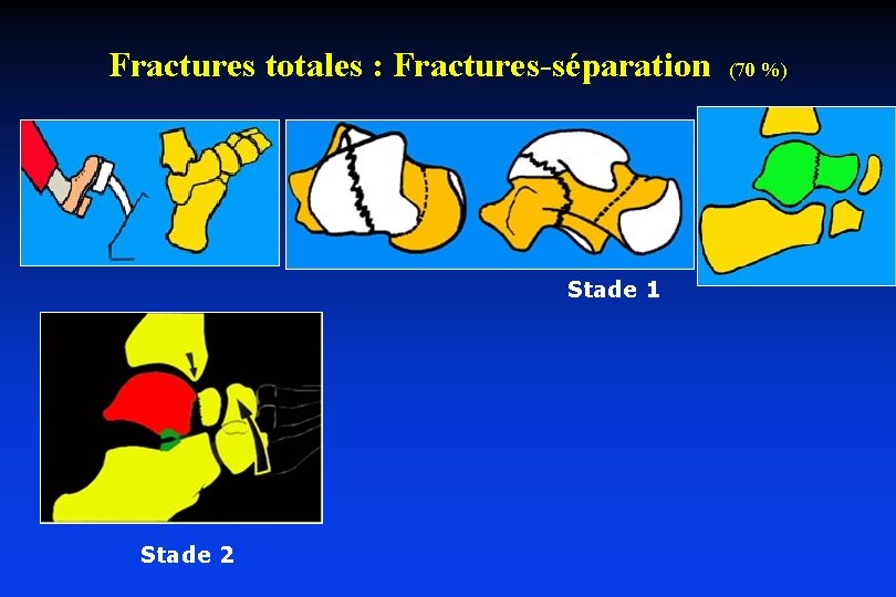 Fractures totales : Fractures-séparation Stade 1 Stade 2 (70 %) 