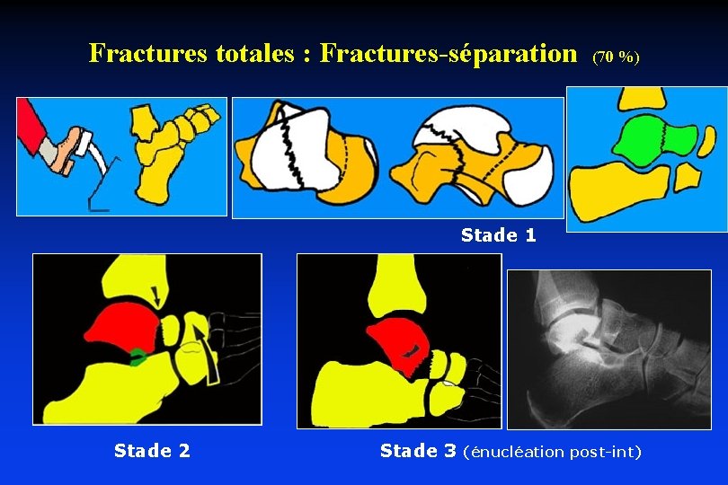 Fractures totales : Fractures-séparation (70 %) Stade 1 Stade 2 Stade 3 (énucléation post-int)