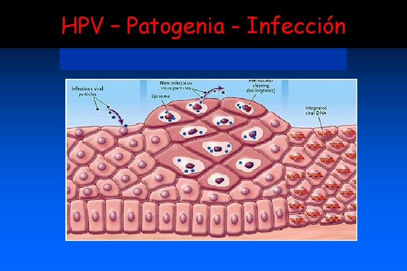 HPV – Patogenia - Infección 