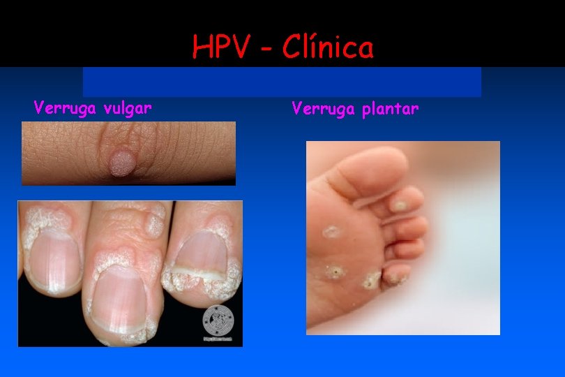 HPV - Clínica Verruga vulgar Verruga plantar 