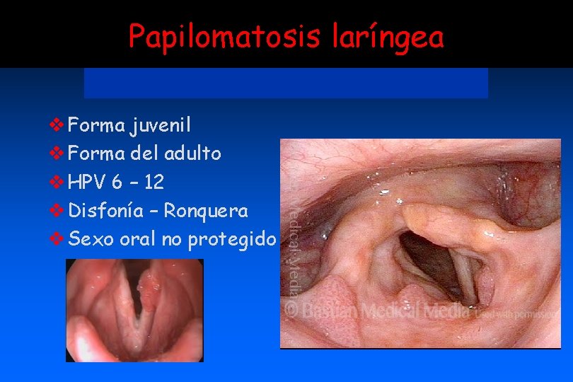 Papilomatosis laríngea v Forma juvenil v Forma del adulto v HPV 6 – 12