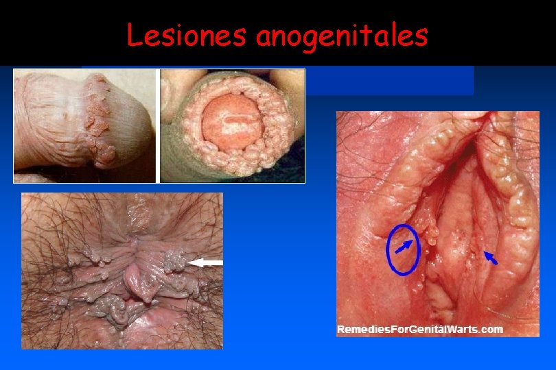 Lesiones anogenitales 