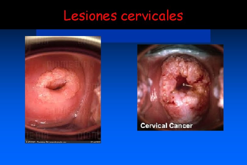 Lesiones cervicales 