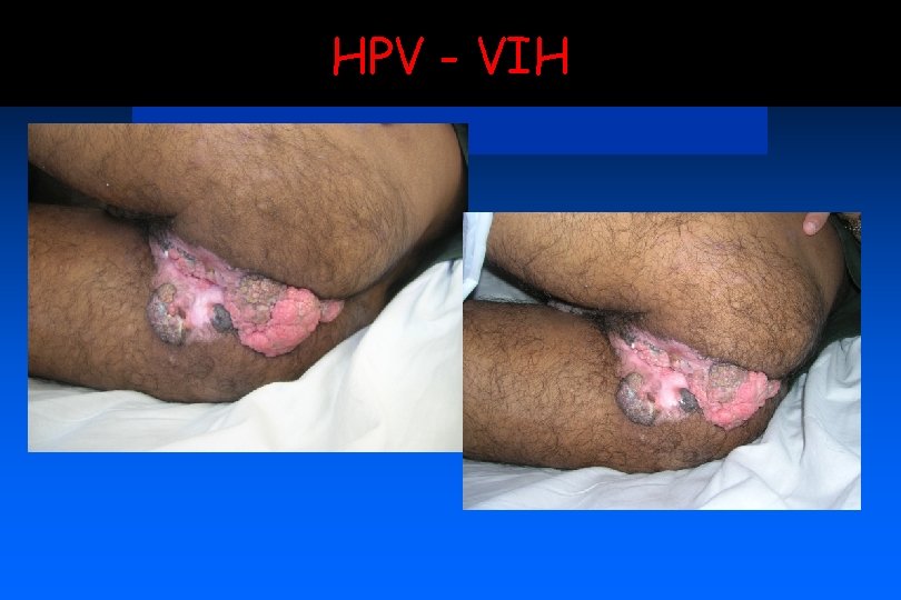 HPV - VIH 