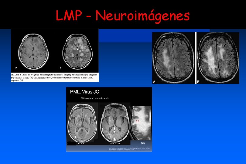 LMP - Neuroimágenes 