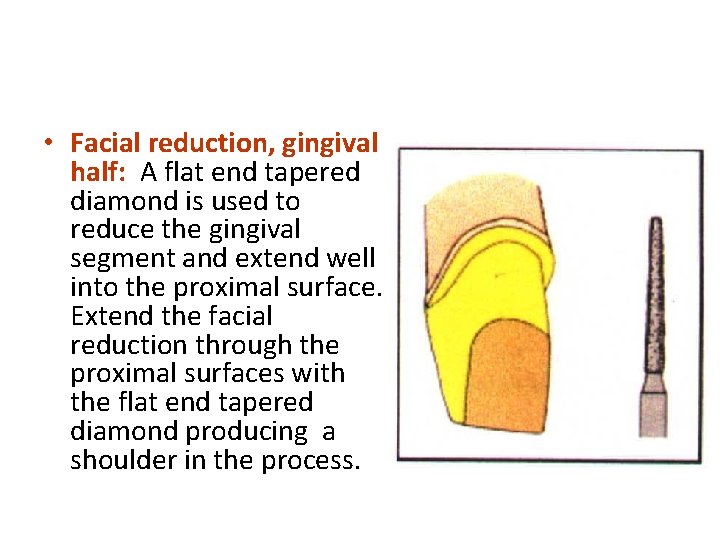  • Facial reduction, gingival half: A flat end tapered diamond is used to