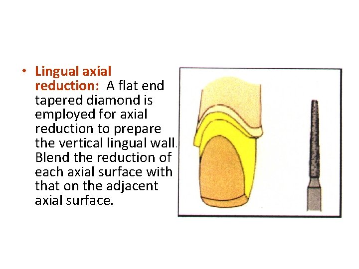  • Lingual axial reduction: A flat end tapered diamond is employed for axial