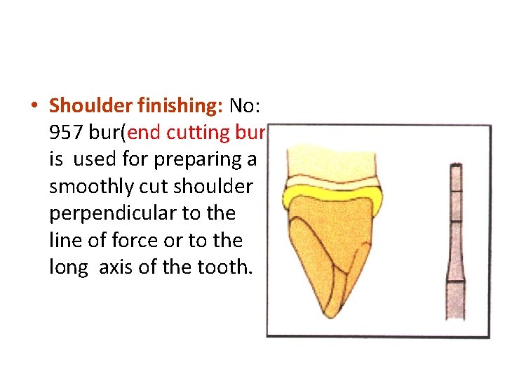  • Shoulder finishing: No: 957 bur(end cutting bur) is used for preparing a