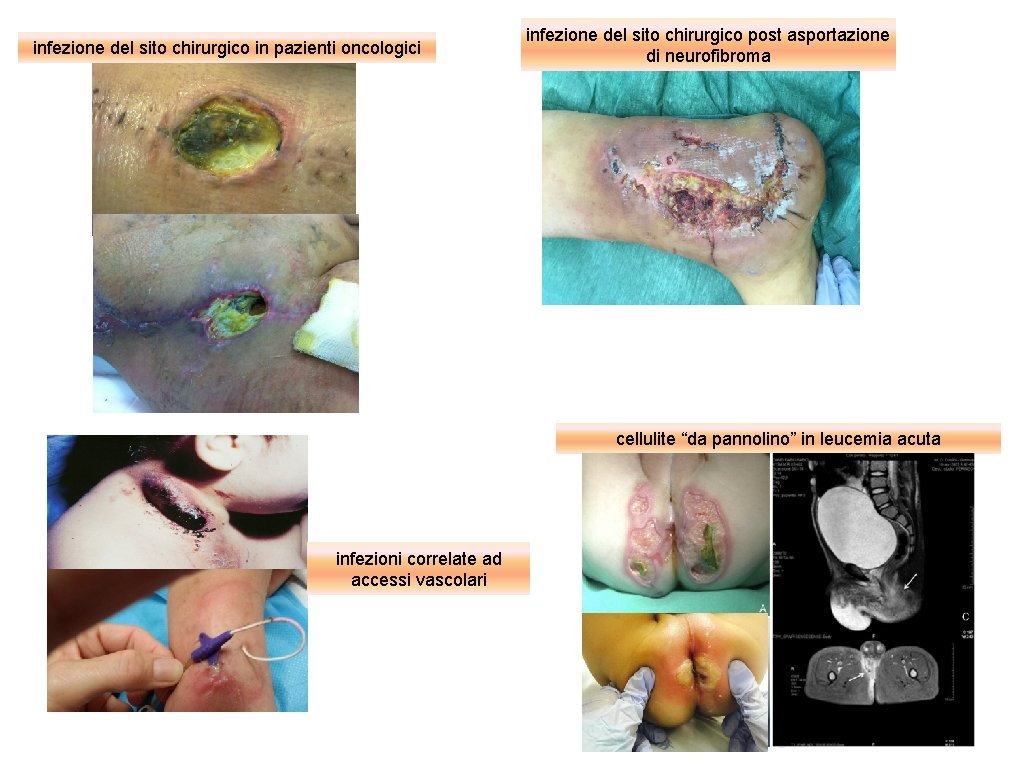 infezione del sito chirurgico in pazienti oncologici infezione del sito chirurgico post asportazione di