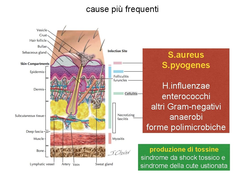 cause più frequenti S. aureus S. pyogenes H. influenzae enterococchi altri Gram-negativi anaerobi forme