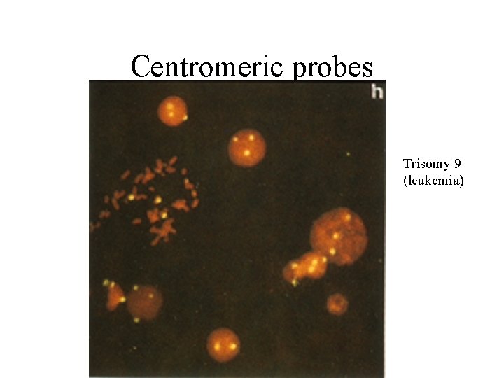 Centromeric probes Trisomy 9 (leukemia) 