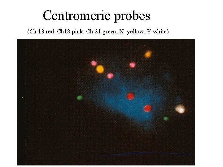 Centromeric probes (Ch 13 red, Ch 18 pink, Ch 21 green, X yellow, Y