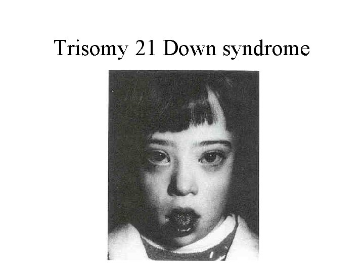 Trisomy 21 Down syndrome 