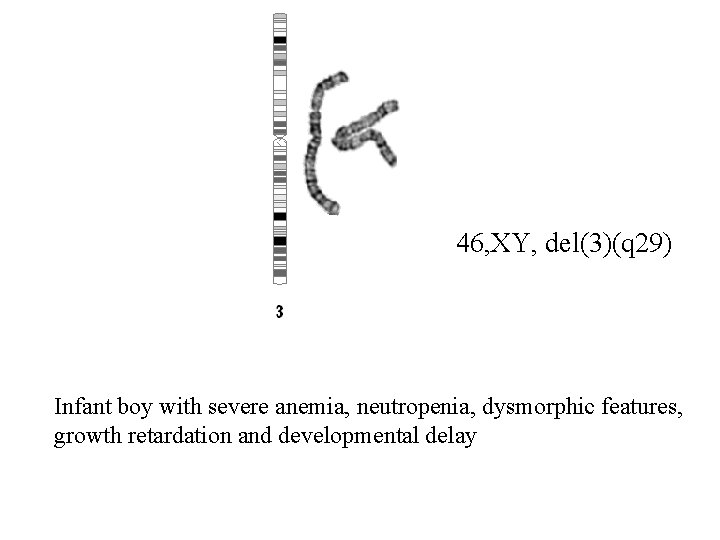 46, XY, del(3)(q 29) Infant boy with severe anemia, neutropenia, dysmorphic features, growth retardation