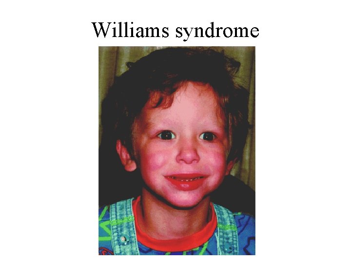 Williams syndrome 