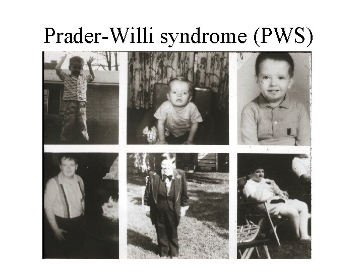 Prader-Willi syndrome (PWS) 