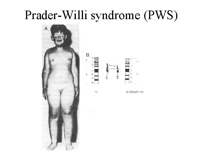 Prader-Willi syndrome (PWS) 