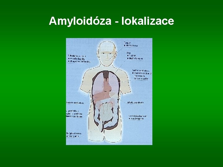 Amyloidóza - lokalizace 