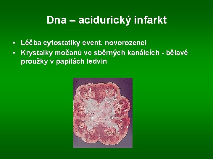 Dna – acidurický infarkt • Léčba cytostatiky event. novorozenci • Krystalky močanů ve sběrných