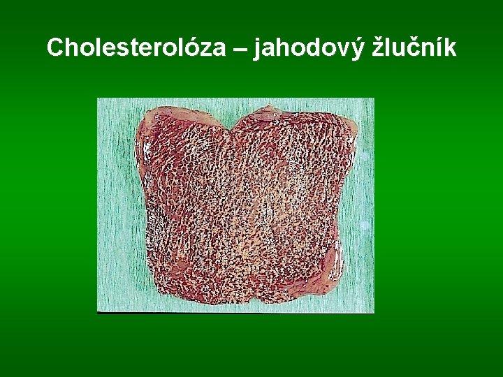 Cholesterolóza – jahodový žlučník 