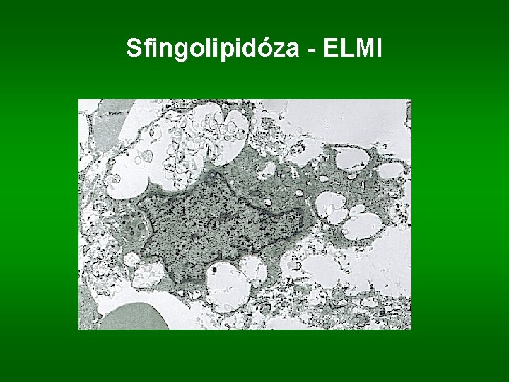 Sfingolipidóza - ELMI 