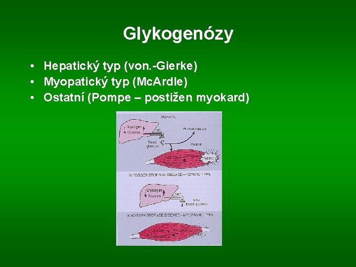 Glykogenózy • Hepatický typ (von. -Gierke) • Myopatický typ (Mc. Ardle) • Ostatní (Pompe