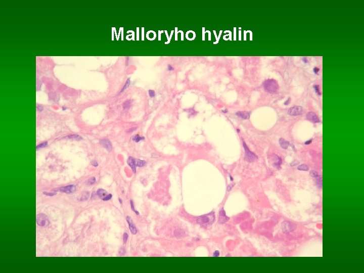 Malloryho hyalin 