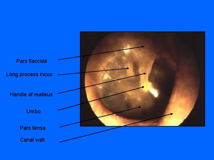 Pars flaccida Long process incus Handle of malleus Umbo Pars tensa Canal wall 