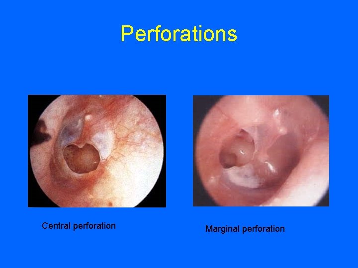 Perforations Central perforation Marginal perforation 