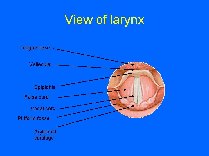 View of larynx Tongue base Vallecula Epiglottis False cord Vocal cord Piriform fossa Arytenoid