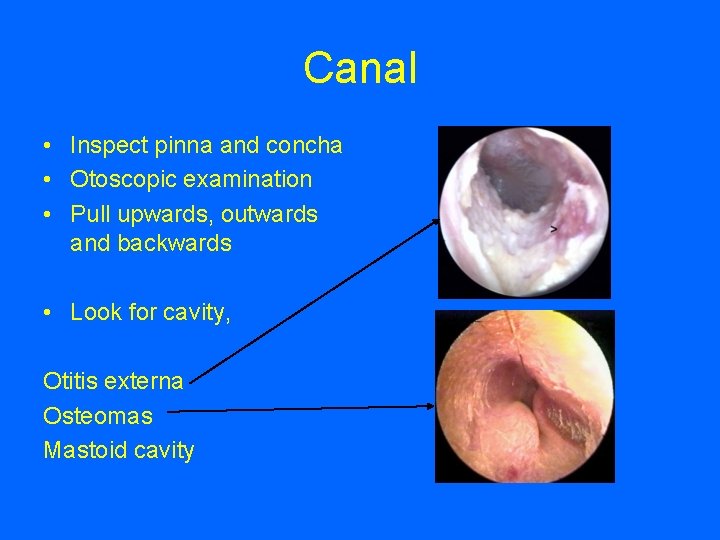 Canal • Inspect pinna and concha • Otoscopic examination • Pull upwards, outwards and