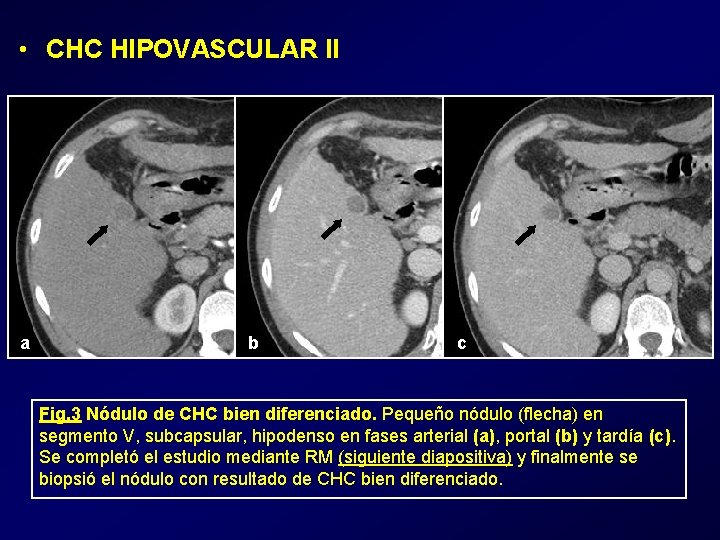  • CHC HIPOVASCULAR II a b c Fig. 3 Nódulo de CHC bien