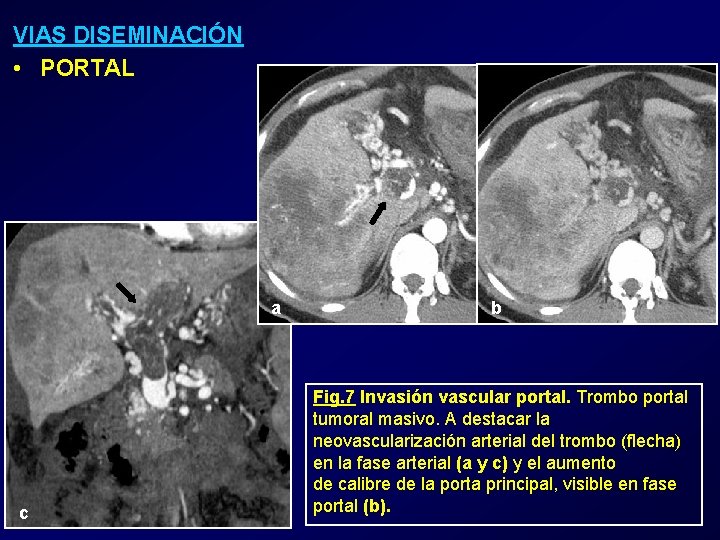 VIAS DISEMINACIÓN • PORTAL a c b Fig. 7 Invasión vascular portal. Trombo portal