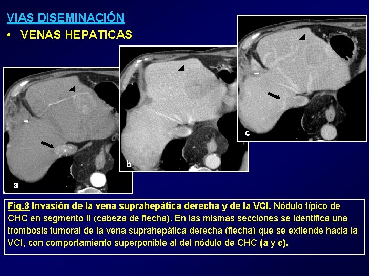 VIAS DISEMINACIÓN • VENAS HEPATICAS c b a Fig. 8 Invasión de la vena