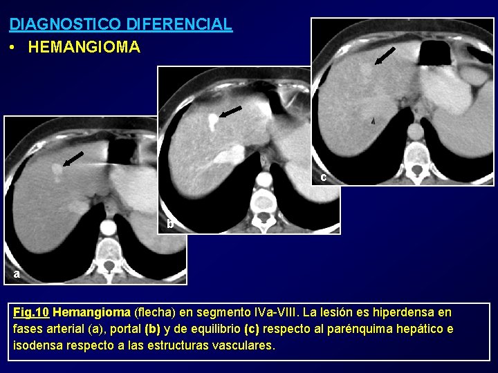 DIAGNOSTICO DIFERENCIAL • HEMANGIOMA c b a Fig. 10 Hemangioma (flecha) en segmento IVa-VIII.