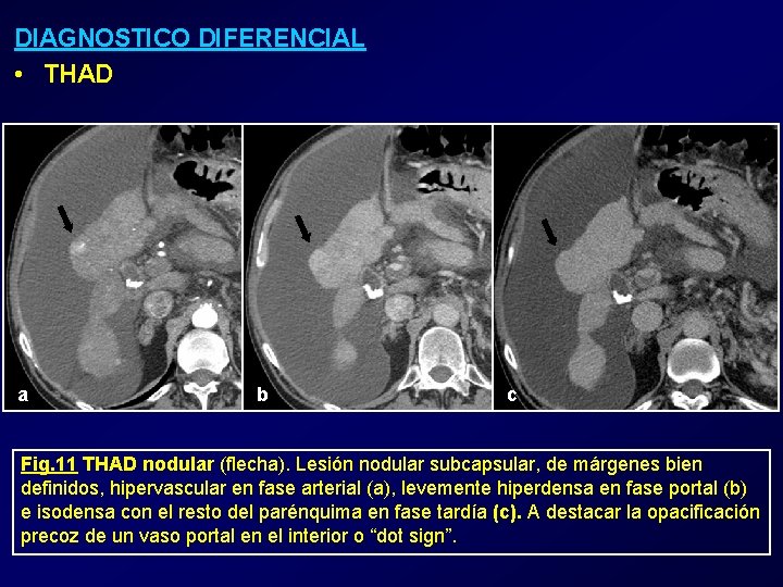 DIAGNOSTICO DIFERENCIAL • THAD a b c Fig. 11 THAD nodular (flecha). Lesión nodular