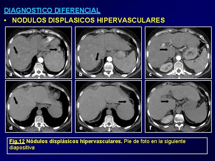 DIAGNOSTICO DIFERENCIAL • NODULOS DISPLASICOS HIPERVASCULARES a b c d e f Fig. 12