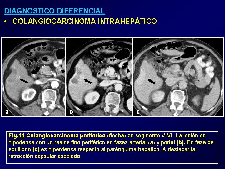 DIAGNOSTICO DIFERENCIAL • COLANGIOCARCINOMA INTRAHEPÁTICO a b c Fig. 14 Colangiocarcinoma periférico (flecha) en