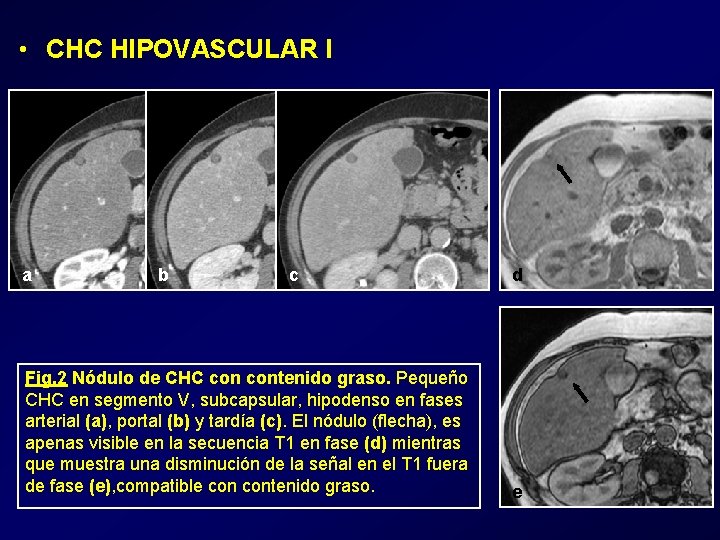  • CHC HIPOVASCULAR I a b c Fig. 2 Nódulo de CHC contenido